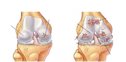 osteoartrita deformantă a articulației genunchiului de gradul I